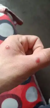  我手上起水泡是不是蚊子咬的