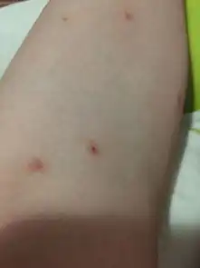  被蚊子咬后一直抓,过了几天咬处变成红色肿块怎么消