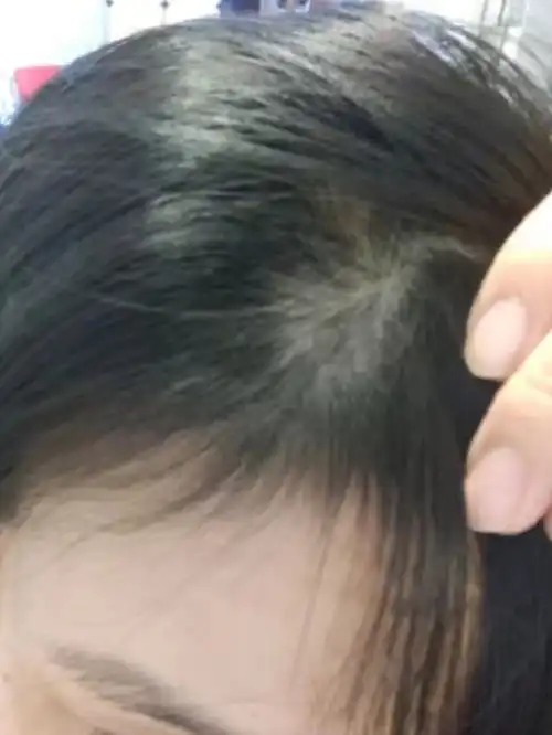 头癣是什么样子的图片