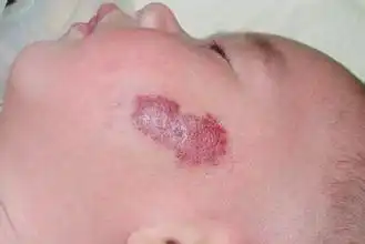  孩子患了血管瘤该怎么办呢专家来给妈妈们补充知识