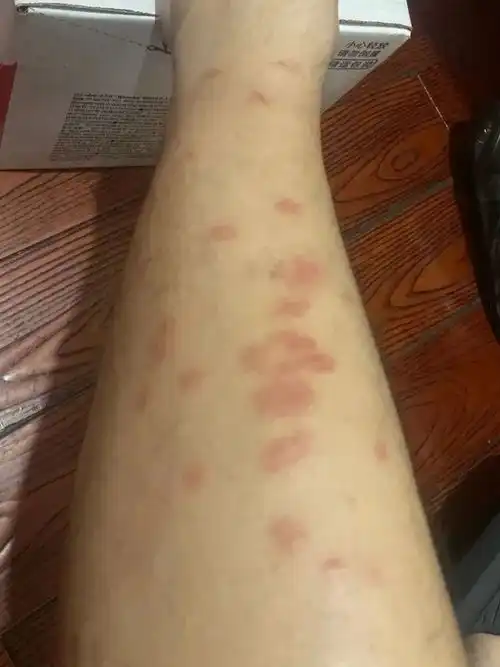  比蚊子还毒被咬后奇痒无比,长时间难以消退多人中招