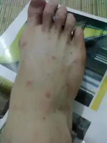  脚上长红点越抓越痒,像蚊子咬了一样