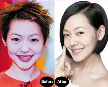  女明星为什么都爱牙齿隐形矫正