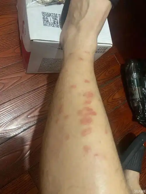  太痒了今年第一批中招的人出现了不少舟山人晒出照片