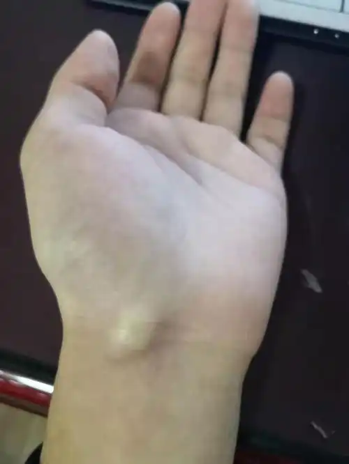  手腕有个鼓包,会有疼痛感