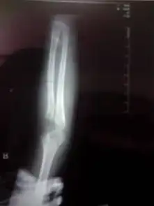  请帮忙看一下这个孩子的肘关节x光片