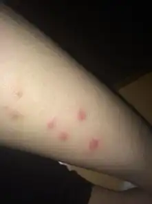  身上长了些红色的东东比蚊子咬的大,有些好了的还有些痒有小水珠,被子晒过热水洗过还长了新的是怎么回事