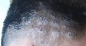  请问这是头癣吗怎么治疗