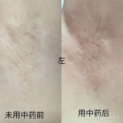  腋臭手术疤痕微创持续更新
