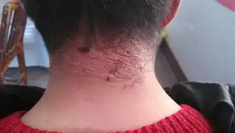  情绪不佳惹神经性皮炎