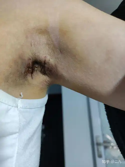  腋臭手术经历