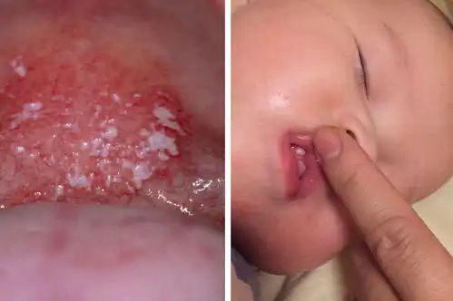  新生儿马牙与鹅口疮,科学区分理性对待