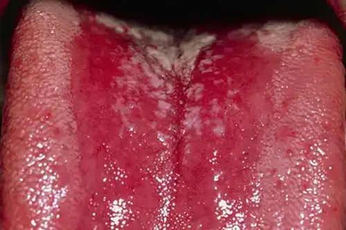 艾滋病早期症状鹅口疮