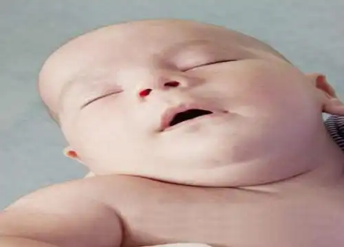 孩子眼皮被蚊子咬肿了怎么快速消肿