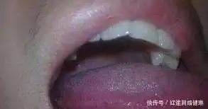  口腔感染是艾滋病的早期症状,遇到可疑hiv感染者如何处理