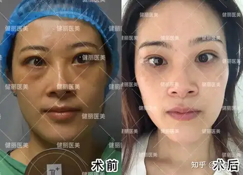  怎么区分黑眼圈和眼袋