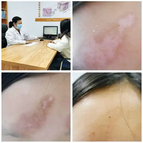  无色素痣图片与白癜风图片对比