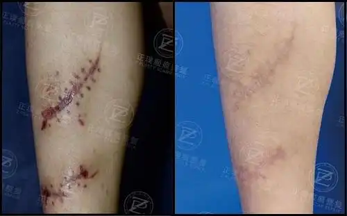  做手术后留下的疤痕能去掉吗祛疤痕多少钱呀
