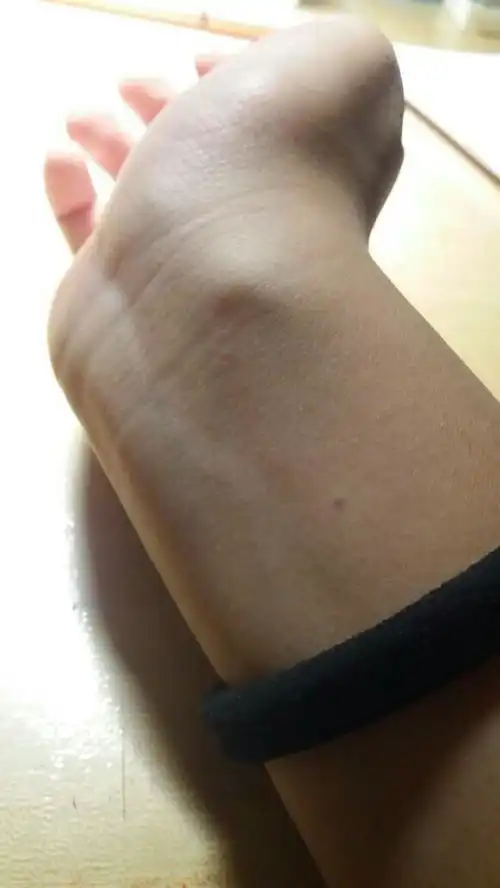  为什么我手腕这里有一个鼓包啊硬硬的,也不疼,不知道咋回事两只手都有,左边的稍微小一点,求解