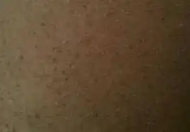  形成神经性皮炎的自我日常护理办法