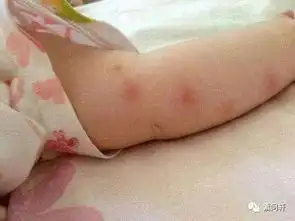  素问活动为什么一到夏天,宝宝就独得蚊子恩宠