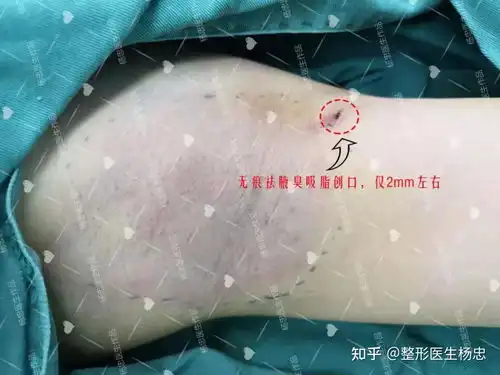  做了狐臭手术,后悔死了......