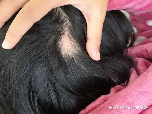  发旋稀疏,没头发,盖都盖不住的该怎么办