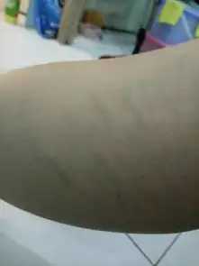  请问这算静脉曲张吗静脉曲张早期是不是这样的,照片上是小腿的位置