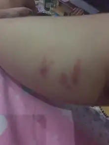  腿上长了好多这种包特别痒是蚊子咬的么