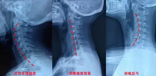颈椎变直正确睡姿图片