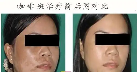  激光治疗咖啡斑后的修复及护理方法