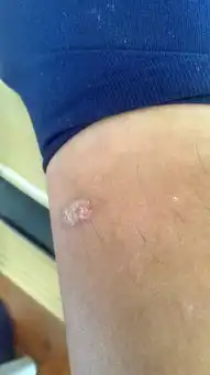  这是什么皮肤病几年前被蚊子叮咬过看图