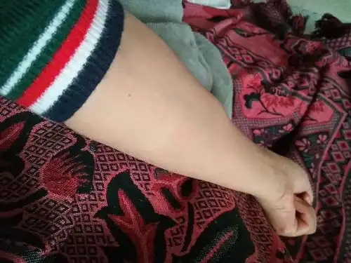  手臂上有个鼓包两三年了,之前也没什么感觉,现在用手指按着有些痛是怎么回事呢