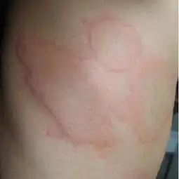  小儿过敏性荨麻疹