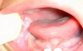  口腔粘膜科的治疗疾病介绍