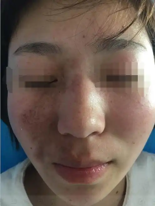  激光洗脸洗掉脸上斑重新做回美少女