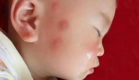  小宝宝被蚊子叮了个大包别着急,去厨房找找三种东西,有奇效