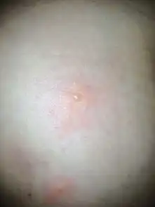  腿上和胳膊上开始起了好多包,类似蚊子咬的,但是挠过之后就出了好多水泡,请问这是怎么回事