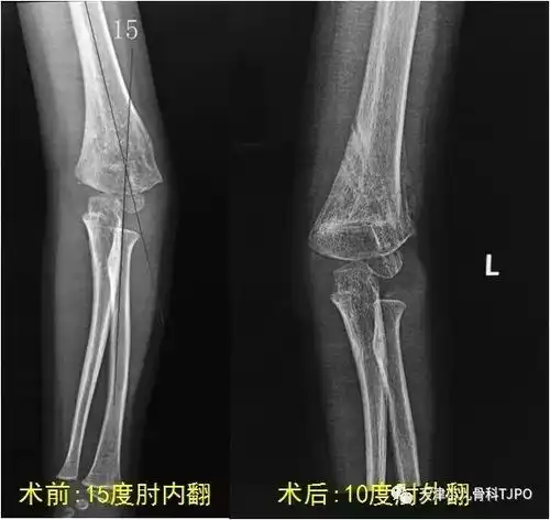 正常儿童肘关节x光片