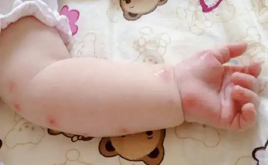  孩子被蚊子咬后难受,这些防蚊小妙招推荐给你,让娃远离蚊虫叮咬