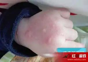  宝宝被蚊子咬了怎么办婴儿被蚊虫叮咬后的紧急处理办法推荐