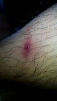  小腿上长了一个包,起初我以为是蚊子咬,现在变成这样了