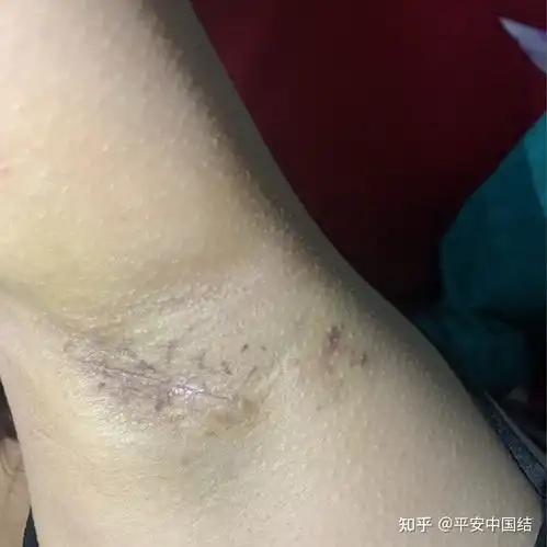  狐臭手术到底有没有用