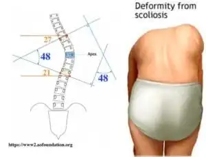  值的医疗脊椎侧弯矫正一定要改变侧面姿势,否则徒劳无功