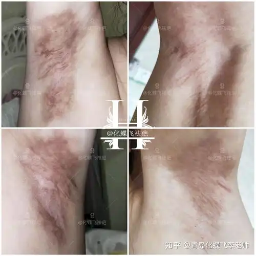  腋下手术疤痕的美女太多了