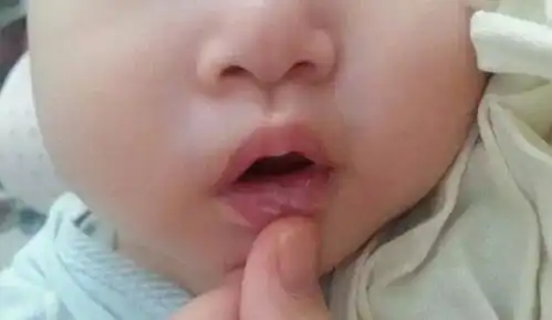  马牙,口腔溃疡,鹅口疮傻不傻分不清区别,护理,治疗方法都在这小宝宝