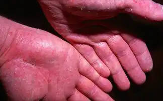  瘙痒难忍就是患了神经性皮炎
