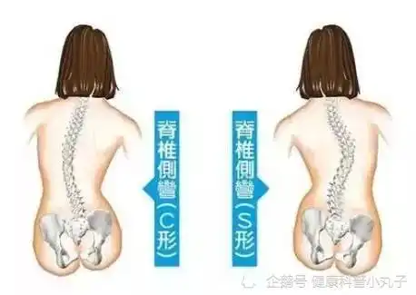  上海强直医院脊柱矫正中心告诉你正确睡姿避免脊柱侧弯