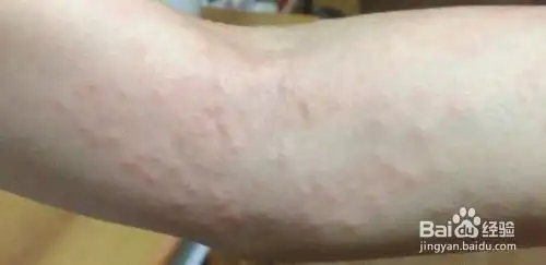  出现湿疹怎么办小湿疹皮肤红点