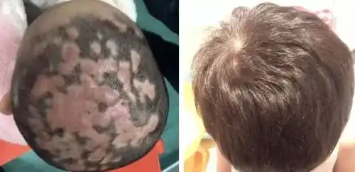  才6岁,女孩头顶就秃了,原因是亲密过度做这事千万要谨慎